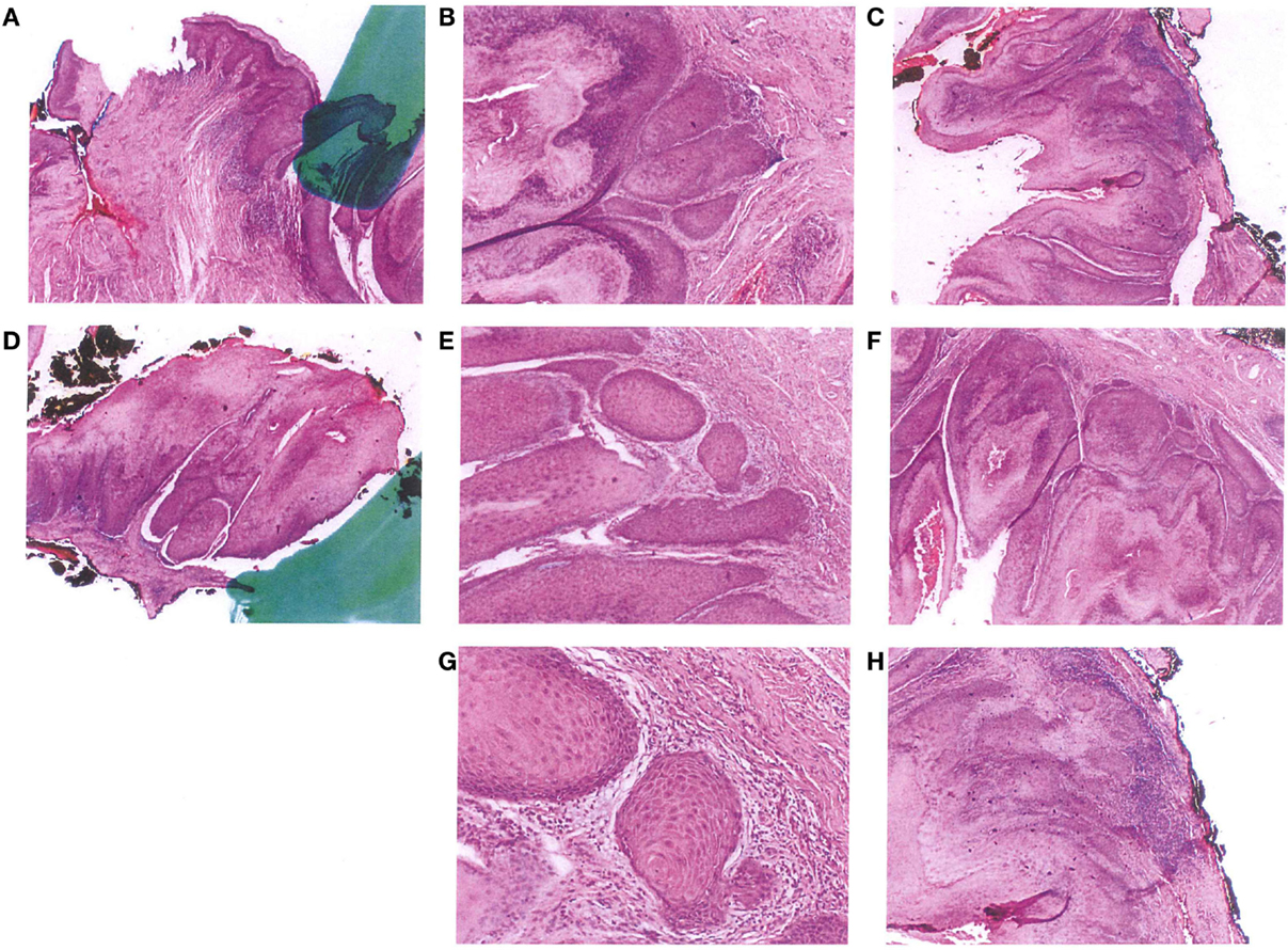 Frontiers Verrucous Carcinoma Of The Vulva A Case Report And Review