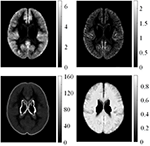 Frontiers | Positive Unanimous Voting Algorithm for Focal Cortical ...