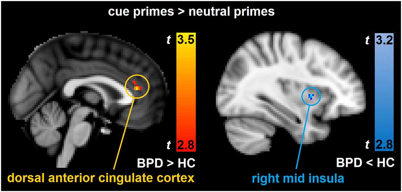 Key Brain Activity Absent in Borderline Personality Disorder - Neuroscience  News