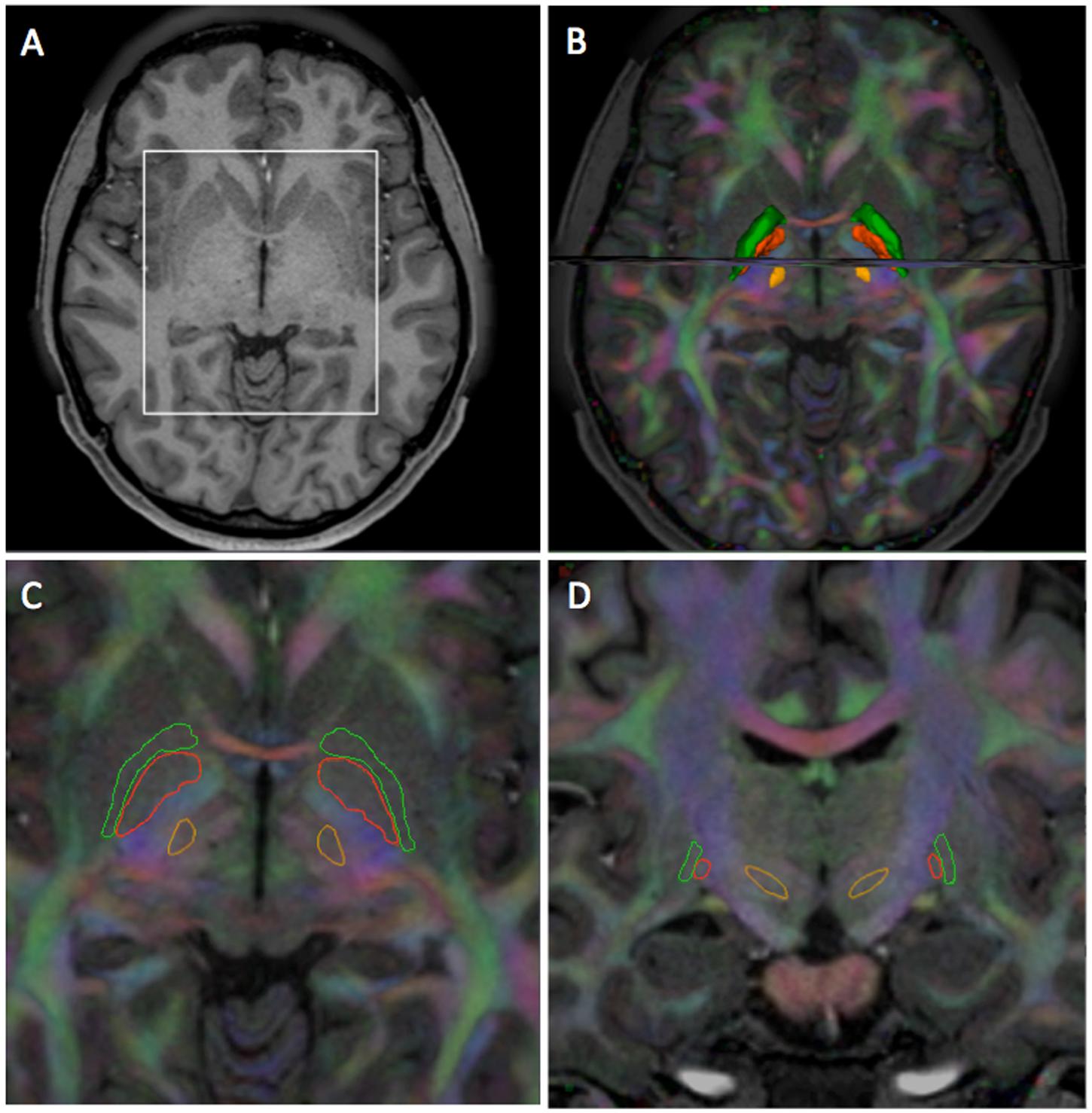 Frontiers  In vivo Exploration of the Connectivity between the Subthalamic  Nucleus and the Globus Pallidus in the Human Brain Using Multi-Fiber  Tractography