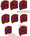 Frontiers | Portal Vein Embolization as an Oncosurgical Strategy Prior ...