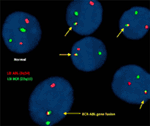 Frontiers | A Novel Four-Way Complex Variant Translocation Involving ...