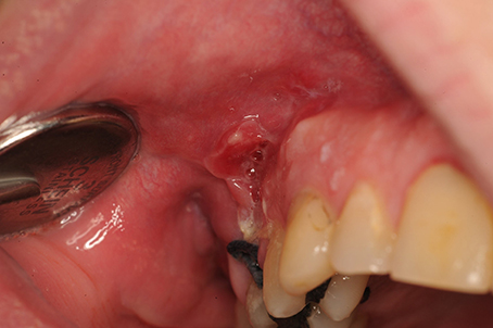 granulation tissue mouth