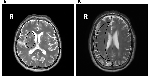 Frontiers | The Relationship between Cerebral Small Vessel Disease ...