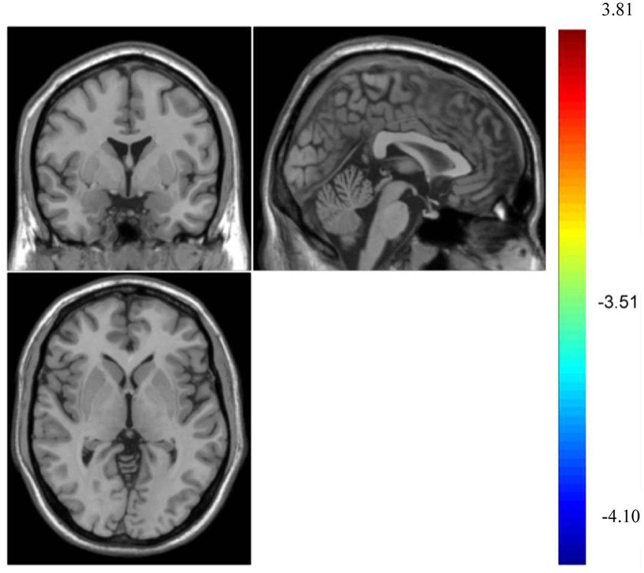 Frontiers  Spontaneous Brain Activity Did Not Show the Effect of Violent Video  Games on Aggression: A Resting-State fMRI Study