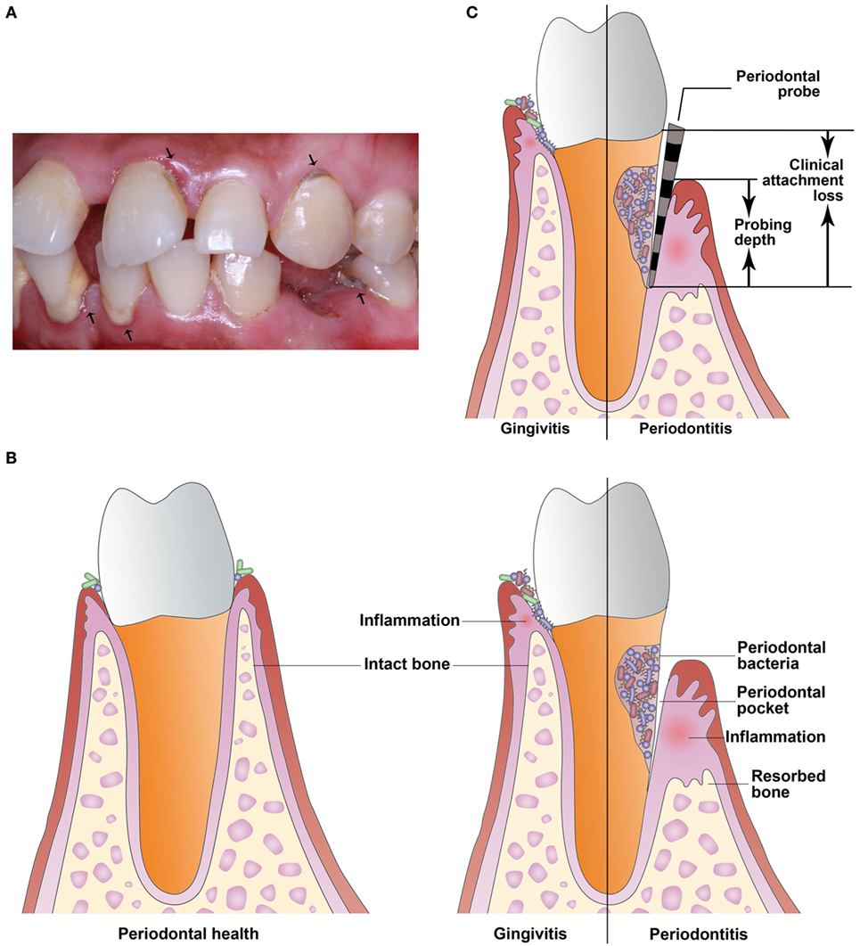 Frontiers  Role of Maternal Periodontitis in Preterm Birth