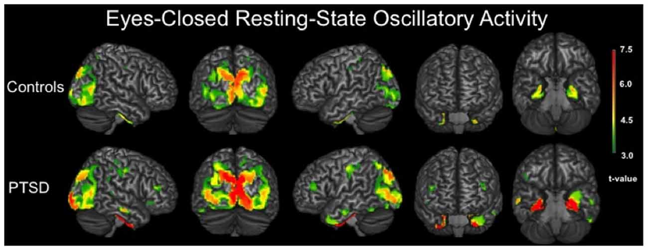 Frontiers Resting-State Abnormalities in Posttraumatic Stress Disorder: A Magnetoencephalography Study