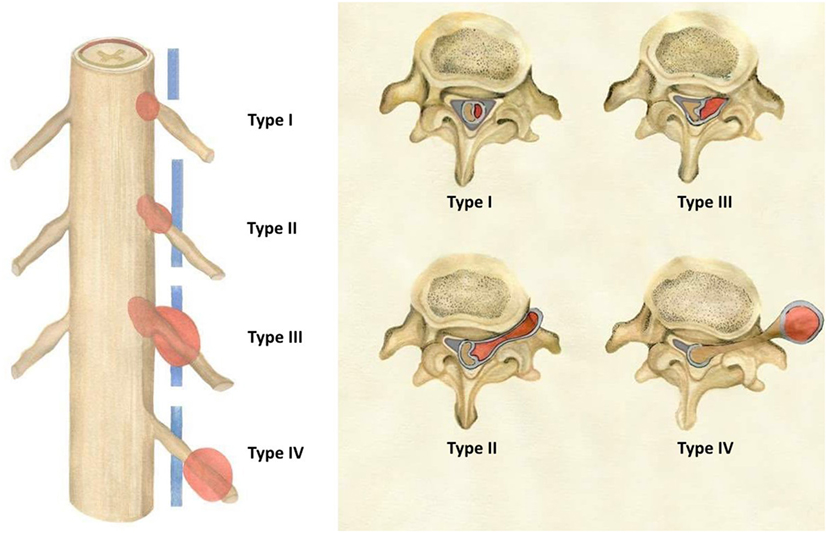 Frontiers | Non-Syndromic Spinal Schwannomas: A Novel Classification