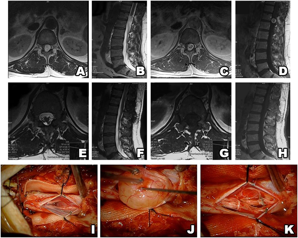 Frontiers | Non-Syndromic Spinal Schwannomas: A Novel Classification