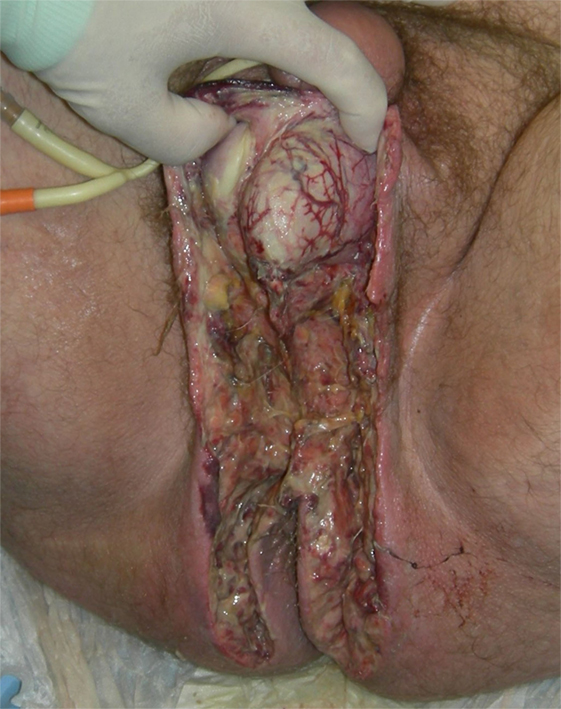 Fournier's gangrene revealing an aggressive squamous cell carcinoma of the  penis: An exceptional case report - ScienceDirect