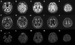 Frontiers | Extensive Delayed Brain Atrophy after Resuscitation in a ...