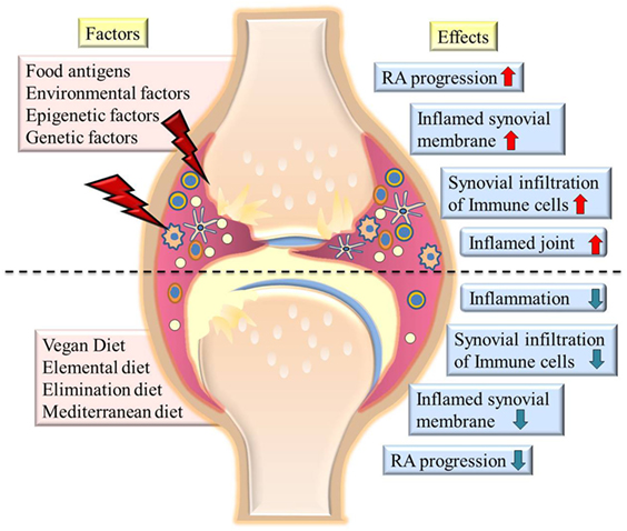 The Link Between Rheumatoid Factor and Rheumatoid Arthritis - Introduction to Rheumatoid Factor and Rheumatoid Arthritis