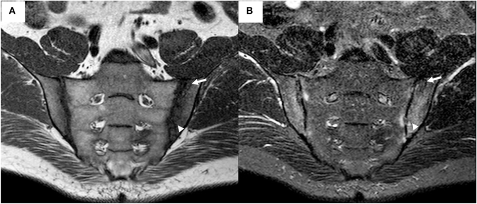 Frontiers | The Role of Imaging in Diagnosing Axial Spondyloarthritis