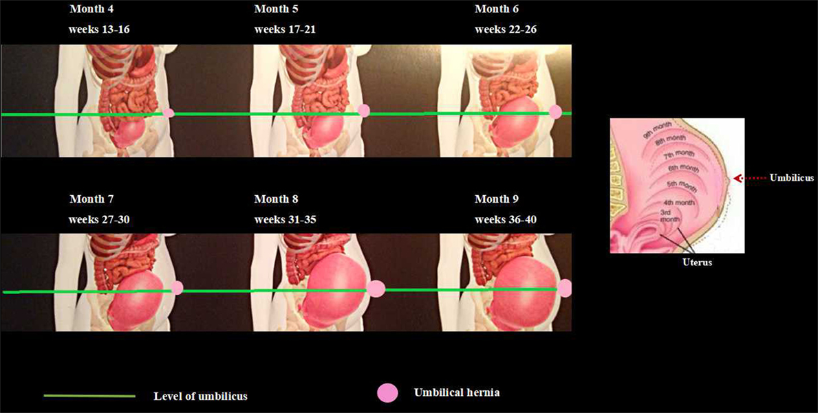 An Epigastric Abdominal Hernia Symptoms for Female
