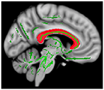 Frontiers | Elevated Aggression And Reduced White Matter Integrity In ...