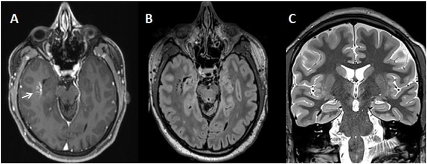 Frontiers  Myoclonic Jerks and Schizophreniform Syndrome: Case Report and  Literature Review