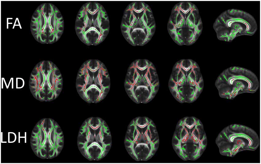 Frontiers | Diffusion Tensor Imaging With Tract-Based Spatial 