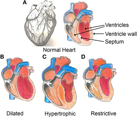 Mending a Broken Heart—The Genetics of Heart Disease · Frontiers