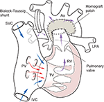 Frontiers | Mechanical Circulatory Support for Single Ventricle Failure ...