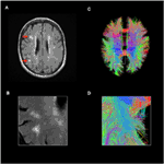 Frontiers | Neurological Disease in Lupus: Toward a Personalized ...