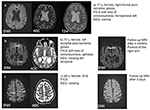 Frontiers | Acute DWI Reductions In Patients After Single Epileptic ...