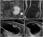 Frontiers | Hyperintense Thyroid Incidentaloma on Time of Flight ...