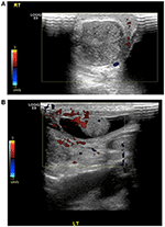 Frontiers | Bilateral Neonatal Testicular Torsion; Hidden Surgical ...