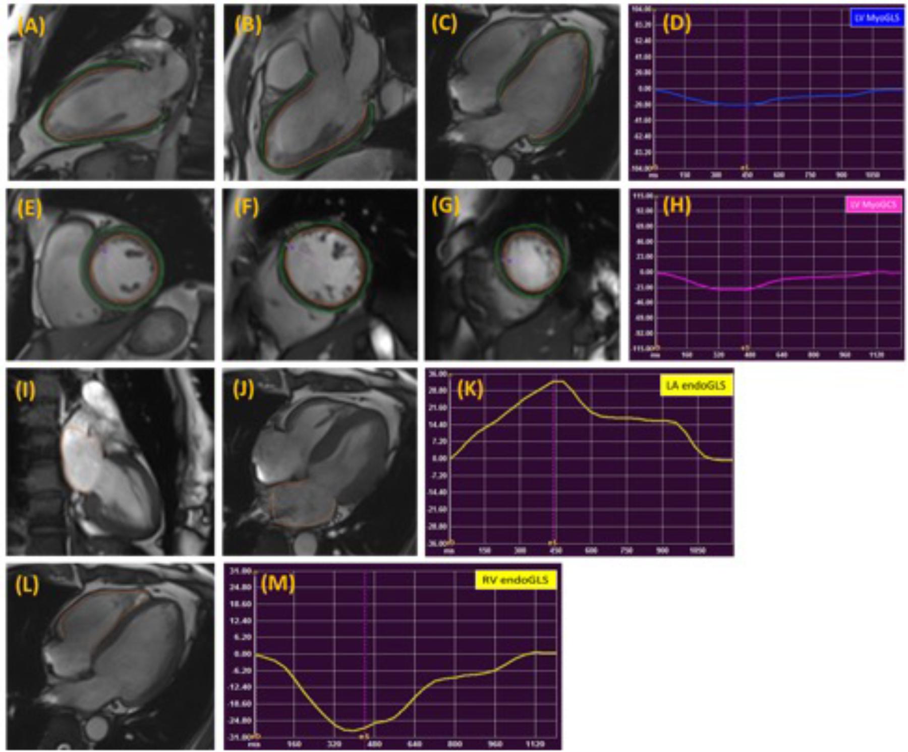 Strain imaging using cardiac magnetic resonance