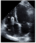 Frontiers | Treatment of Tricuspid Regurgitation With the FORMA Repair ...