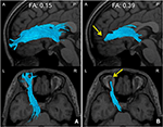 fa threshold in medinria for mice brain