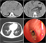 Frontiers | Liver Failure in a Chinese Cystic Fibrosis Child With ...