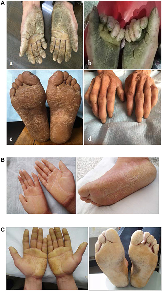 FOOT RASPING DAY! The other foot -- with EPPK Keratoderma