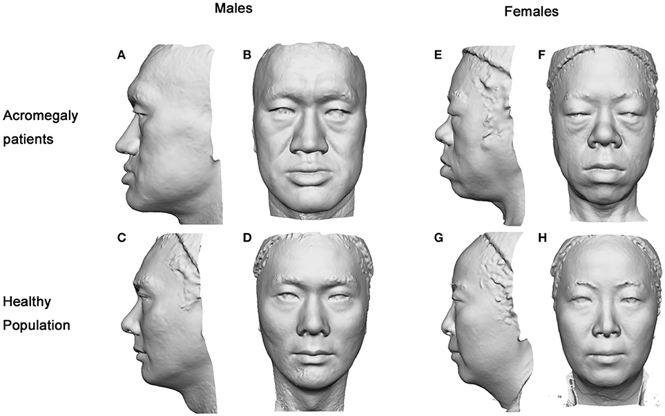 Frontiers 3d Facial Analysis In Acromegaly Gender Specific Features