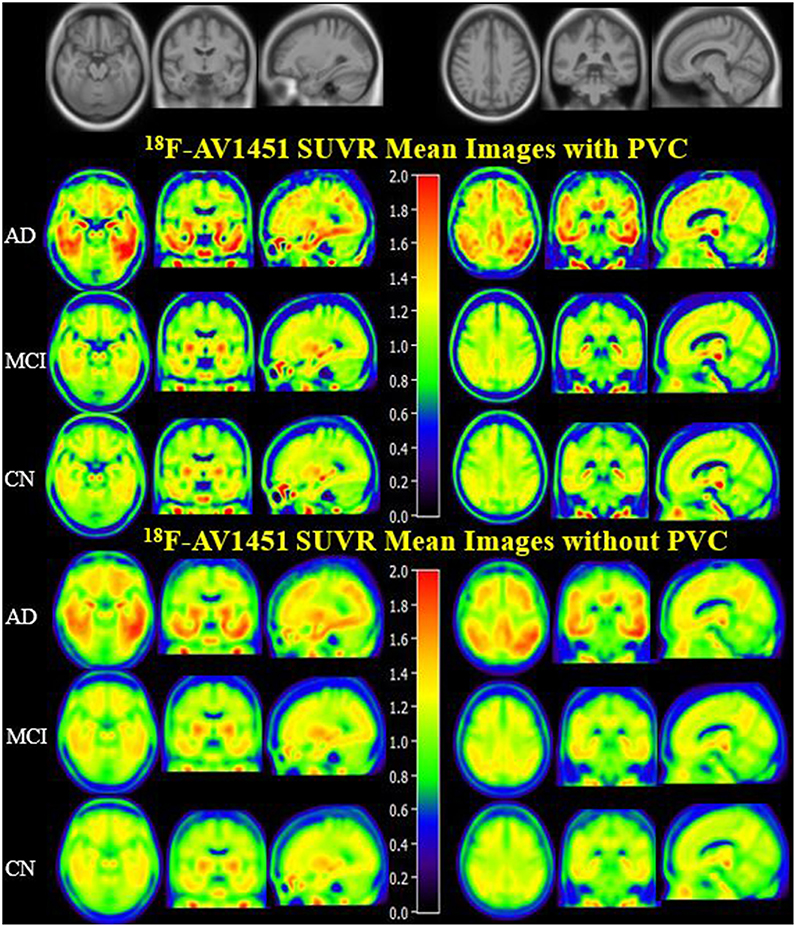 Frontiers Quantitative 18F-AV1451 Brain Tau PET Imaging in Cognitively Normal Older Adults, Mild Cognitive Impairment, and Alzheimer's Disease Patients