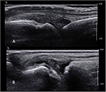 Frontiers | Ultrasound-Guided Synovial Biopsies of Wrists ...