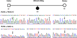 Frontiers | Exome Analysis Identifies a Novel Compound Heterozygous ...