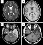 Frontiers | Effect of Clozapine on Anti-N-Methyl-D-Aspartate Receptor ...