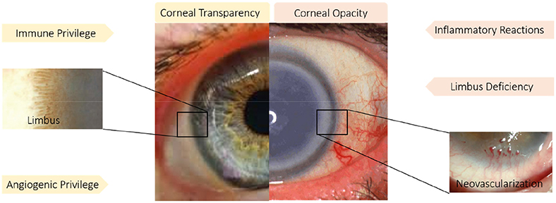 Get Limbus External Eye Anatomy Pictures