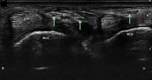 Frontiers  Clinical and Ultrasonographic Features of Distal Ulnar