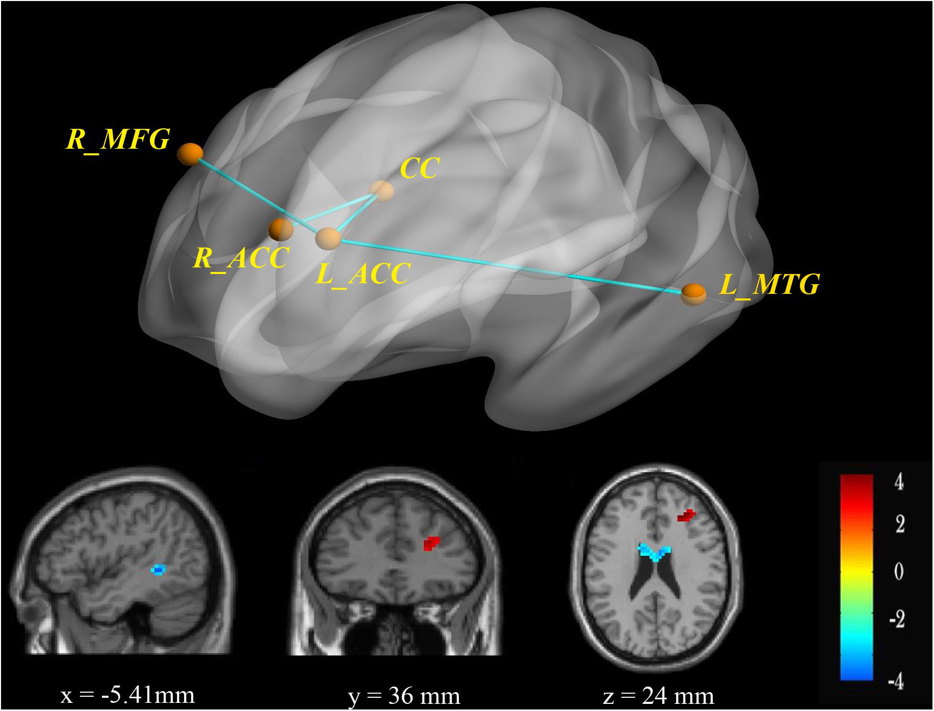Frontiers Structural And Functional Connectivity Of The Anterior Cingulate Cortex In Patients With Borderline Personality Disorder Neuroscience