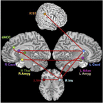 Frontiers | Network Alterations in Comorbid Chronic Pain and Opioid ...