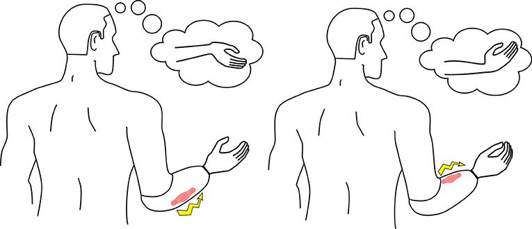 图3——当只失踪,手前臂的肌肉用来控制肌假肢。