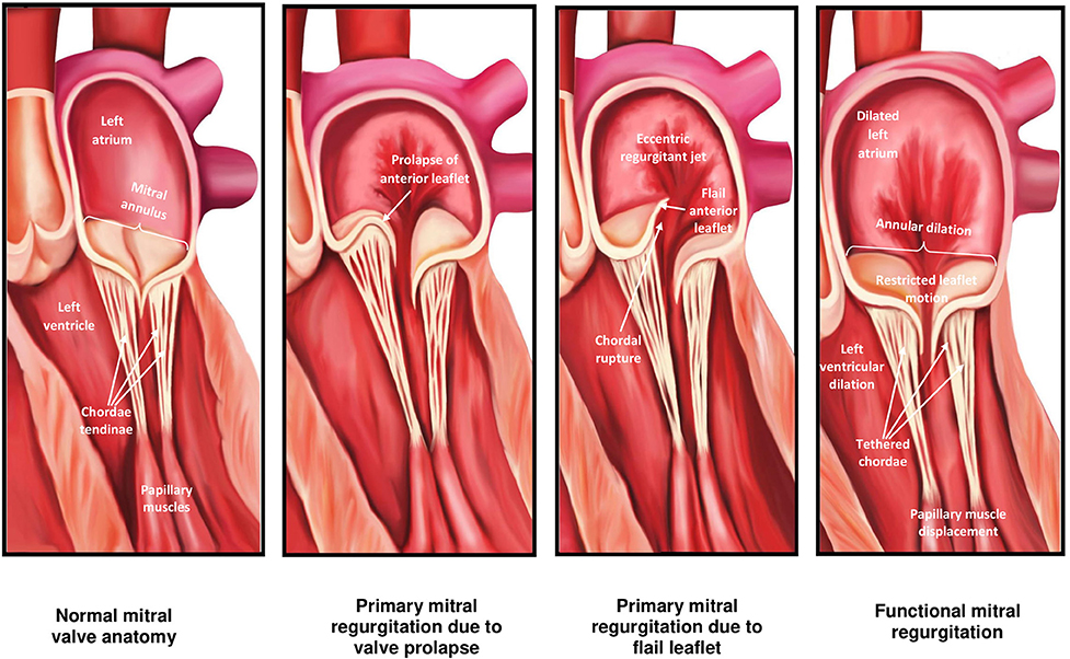 percutaneous mitral valve replacement