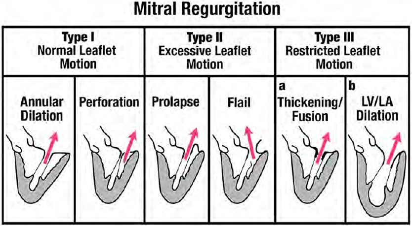 mitral valve posterior leaflet