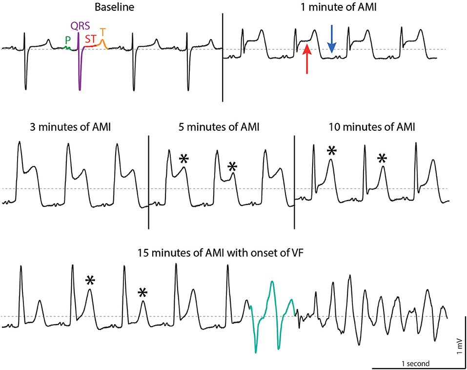 Rapid ID - EKG & Myocardial Infarction