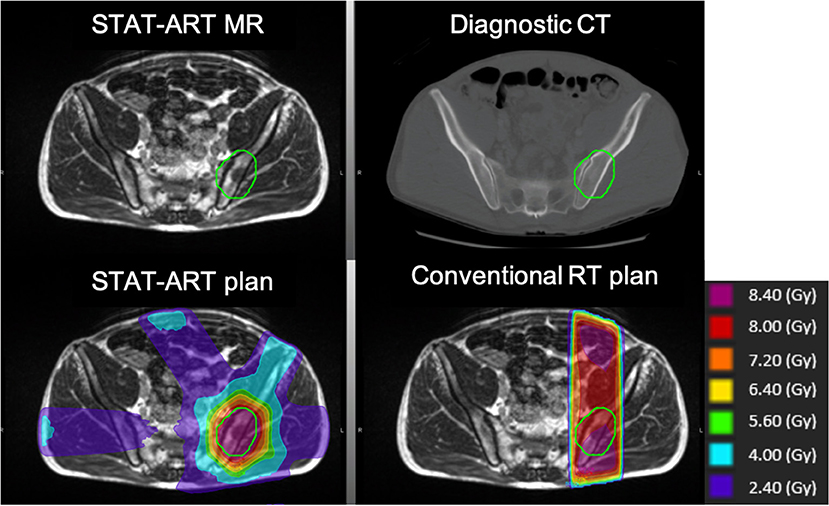 Frontiers Stat Art The Promise And Practice Of A Rapid Palliative Single Session Of Mr Guided Online Adaptive Radiotherapy Art Oncology