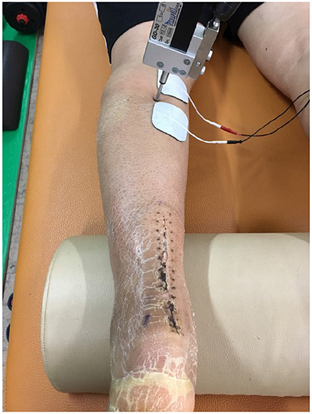 Spontaneous Bilateral Medial Head Of Gastrocnemius Muscle Rupture BMJ Case  Reports
