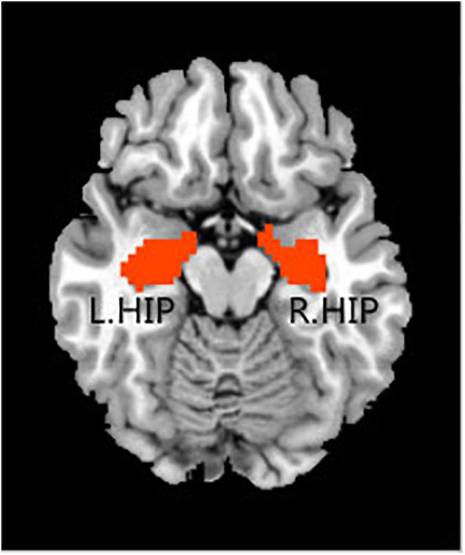 Frontiers Altered Directed Functional Connectivity Of The Hippocampus In Mild Cognitive Impairment And Alzheimer S Disease A Resting State Fmri Study Aging Neuroscience