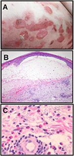 Frontiers | The Intersection Of IgE Autoantibodies And Eosinophilia In ...