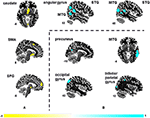 Frontiers | A Multimodal Meta-Analysis of Structural and Functional ...